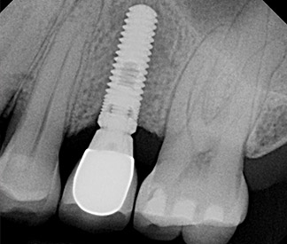 Dental Implants