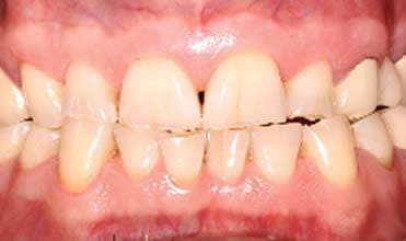 Share 133+ brittle teeth and nails best - songngunhatanh.edu.vn